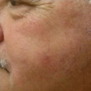 BBL Photofacial capillaries and redness results case 1