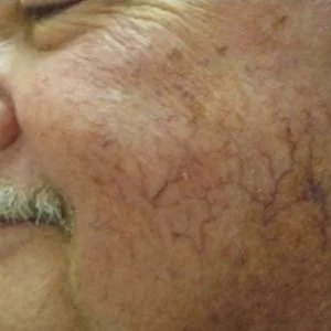 BBL Photofacial capillaries and redness before case 1