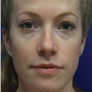 BBL Photofacial pigment and freckles results case 2
