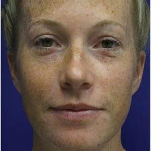 BBL Photofacial pigment and freckles before case 2