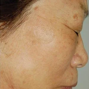 BBL Photofacial sun spot and hyperpigmentation results case 3