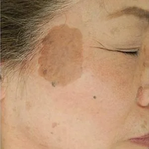 BBL Photofacial sun spot and hyperpigmentation before case 3