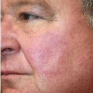 BBL Photofacial facial redness and rosacea results case 4