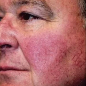 BBL Photofacial facial redness and rosacea before case 4