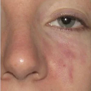 BBL Photofacial port wine stain birthmark results case 5