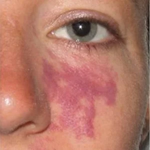 BBL Photofacial port wine stain birthmark before case 5