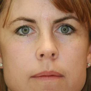 BBL Photofacial sun damage and skin tone results case 6