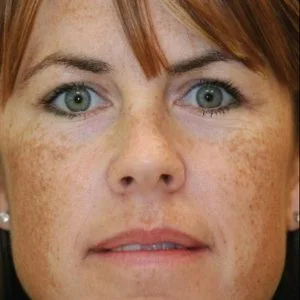 BBL Photofacial sun damage and skin tone before case 6