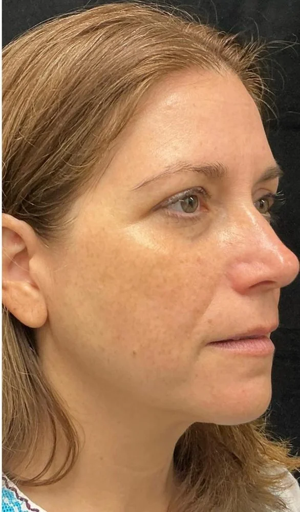 BBL Photofacial treatment results case 7