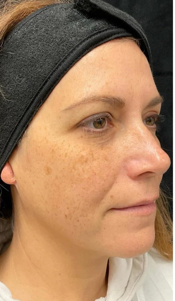 BBL Photofacial treatment before case 7