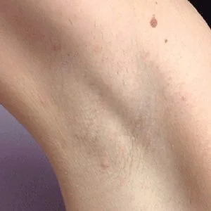 BBL Forever Bare hair reduction results case 1