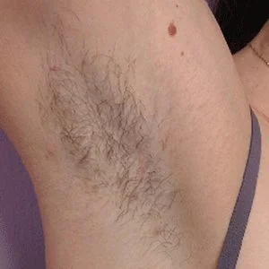 BBL Forever Bare hair reduction before case 1