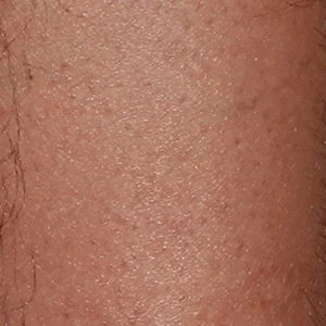 BBL Forever Bare hair reduction results case 2