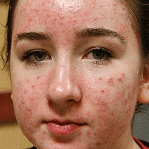 BBL Forever Clear acne reduction before case 1