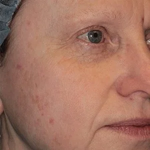 BBL Forever Clear acne reduction results case 2