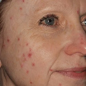 BBL Forever Clear acne reduction before case 2