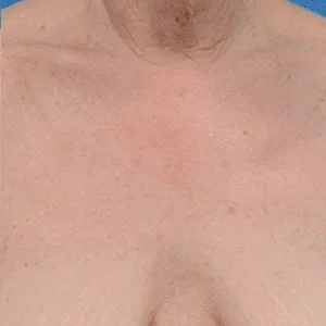 BBL Forever Young skin rejuvenation results case 1