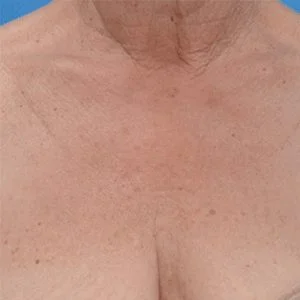 BBL Forever Young skin rejuvenation before case 1