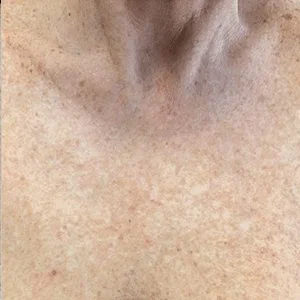 BBL Forever Young skin rejuvenation results case 2