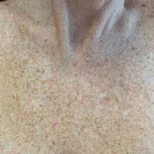 BBL Forever Young skin rejuvenation before case 2