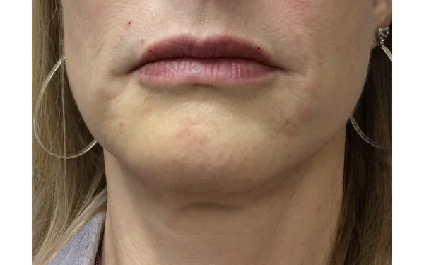 Glabellar Lines After treatment