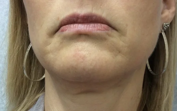 Glabellar Lines Before treatment