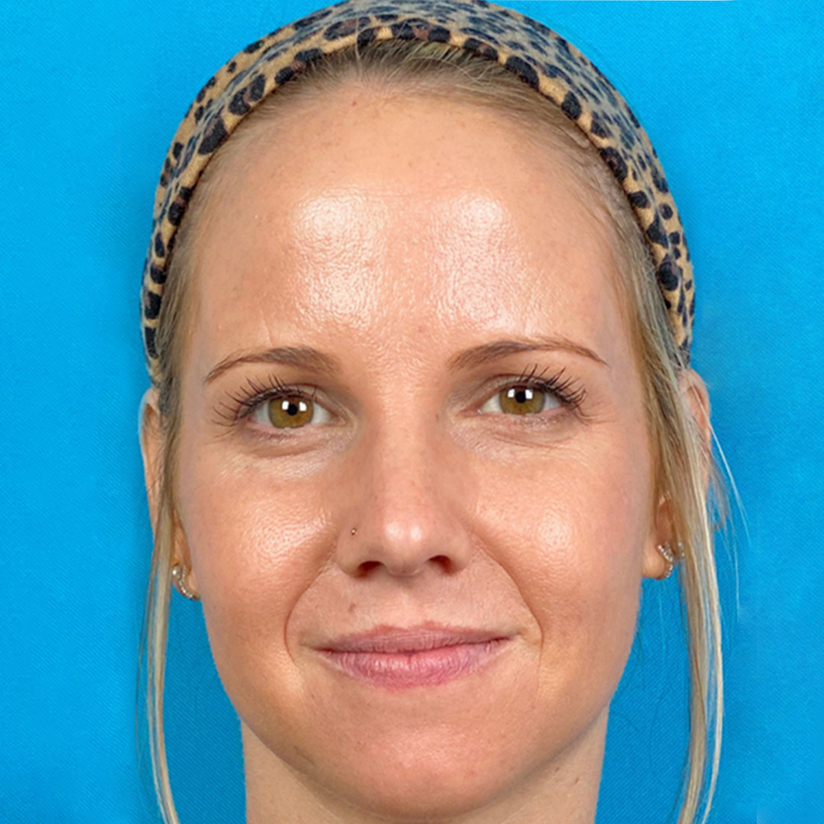 HALO Laser skin resurfacing results case 1
