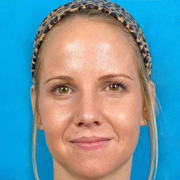 HALO Laser skin resurfacing results case 1