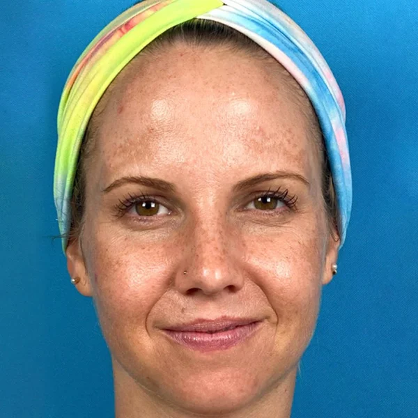 HALO Laser skin resurfacing before case 1