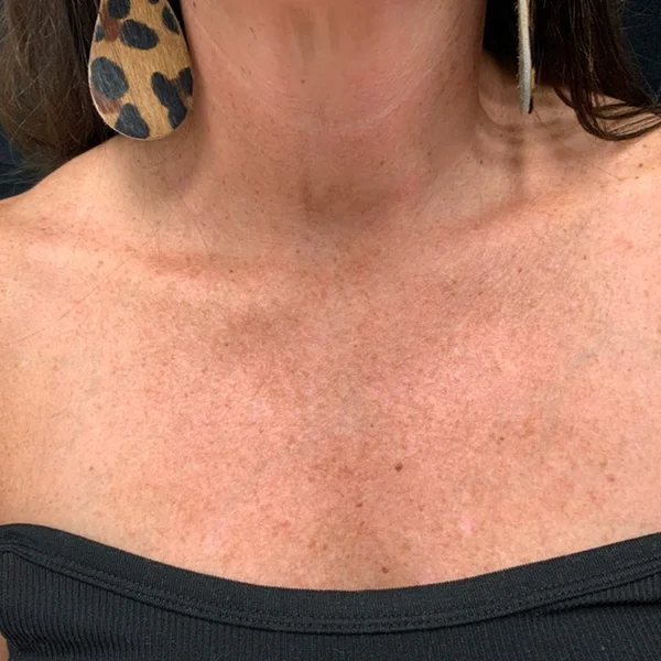 HALO Laser skin resurfacing results case 2