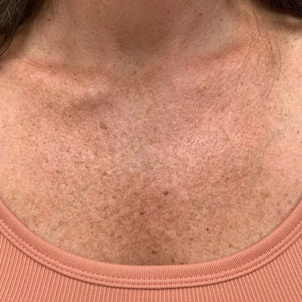 HALO Laser skin resurfacing before case 2