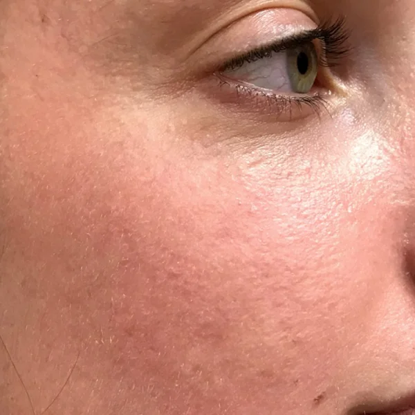 HALO Laser skin resurfacing results case 3