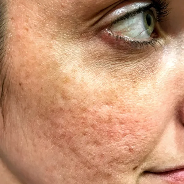 HALO Laser skin resurfacing before case 3