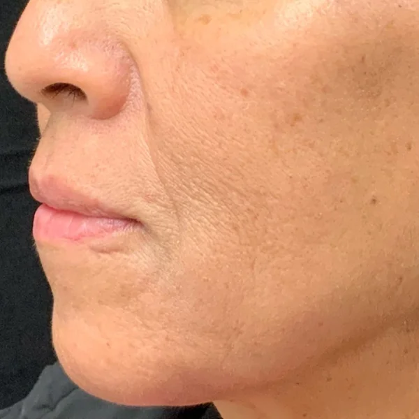 HALO Laser skin resurfacing results case 4