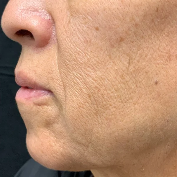 HALO Laser skin resurfacing before case 4