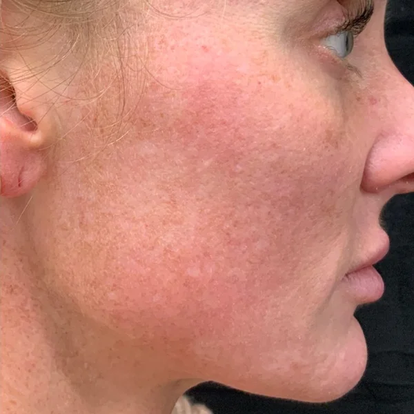 HALO Laser skin resurfacing results case 5