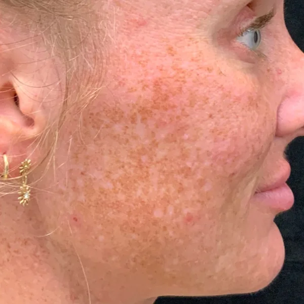HALO Laser skin resurfacing before case 5