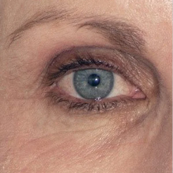 HALO Laser skin resurfacing results case 6