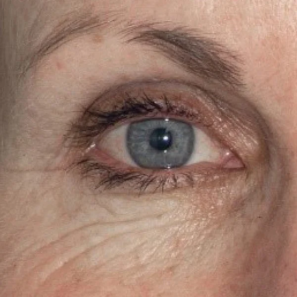 HALO Laser skin resurfacing before case 6
