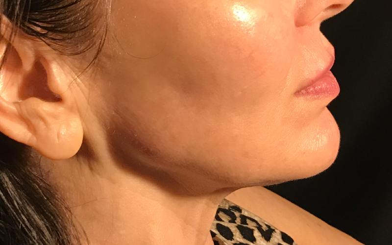 Jawline After treatment