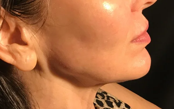 Jawline After treatment