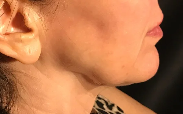 Jawline Before treatment