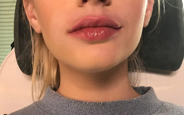 Lips After treatment