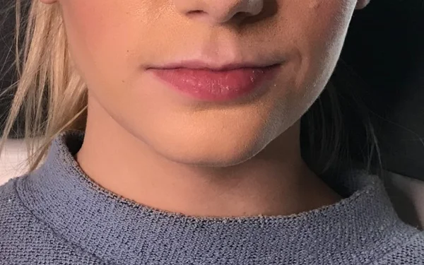 Lips Before treatment