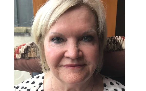 Lower Face After treatment