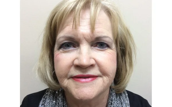 Lower Face Before treatment