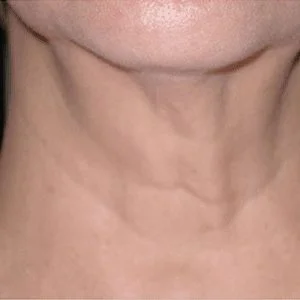 SkinTyte skin tightening results case 1