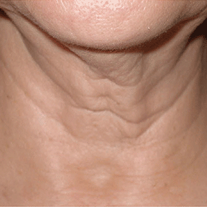 SkinTyte skin tightening before case 1