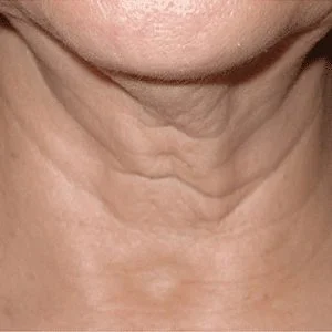 SkinTyte skin tightening before case 1