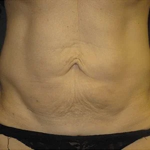 SkinTyte skin tightening results case 2